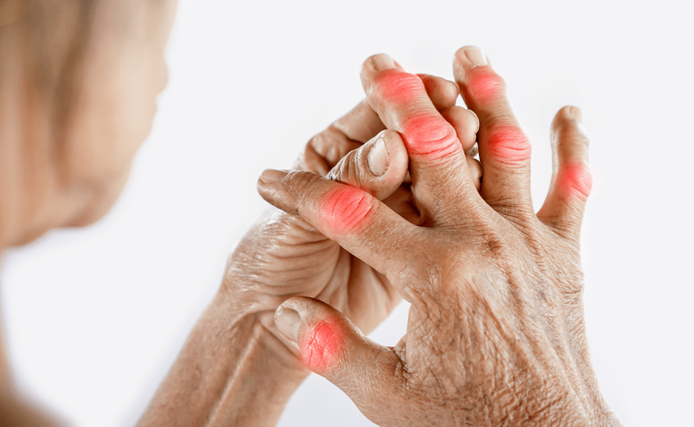 Inflammation and reactive oxygen species in arthritis: therapeutic potential of Ayurvedic medicinal plants